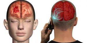 Legătura dintre telefonul mobil și cancerul la creier