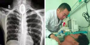 Chinezul care a trăit timp de un an cu o lingură în esofag   Incredibilia.ro